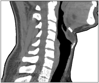 Feasibility of neck electrical impedance tomography to monitor upper airway dynamics during sleep